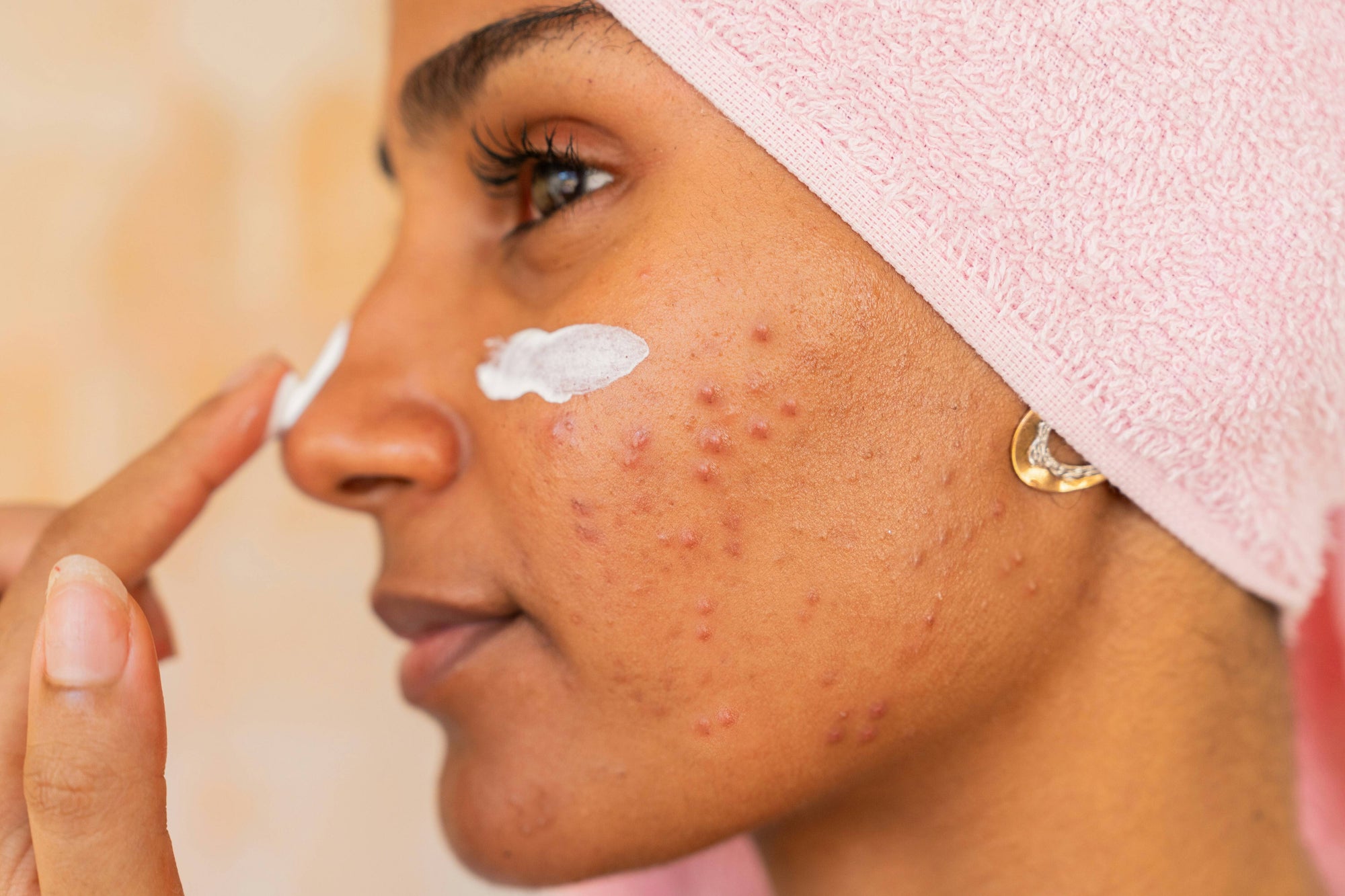The Best Sunscreen for Acne-Prone Skin